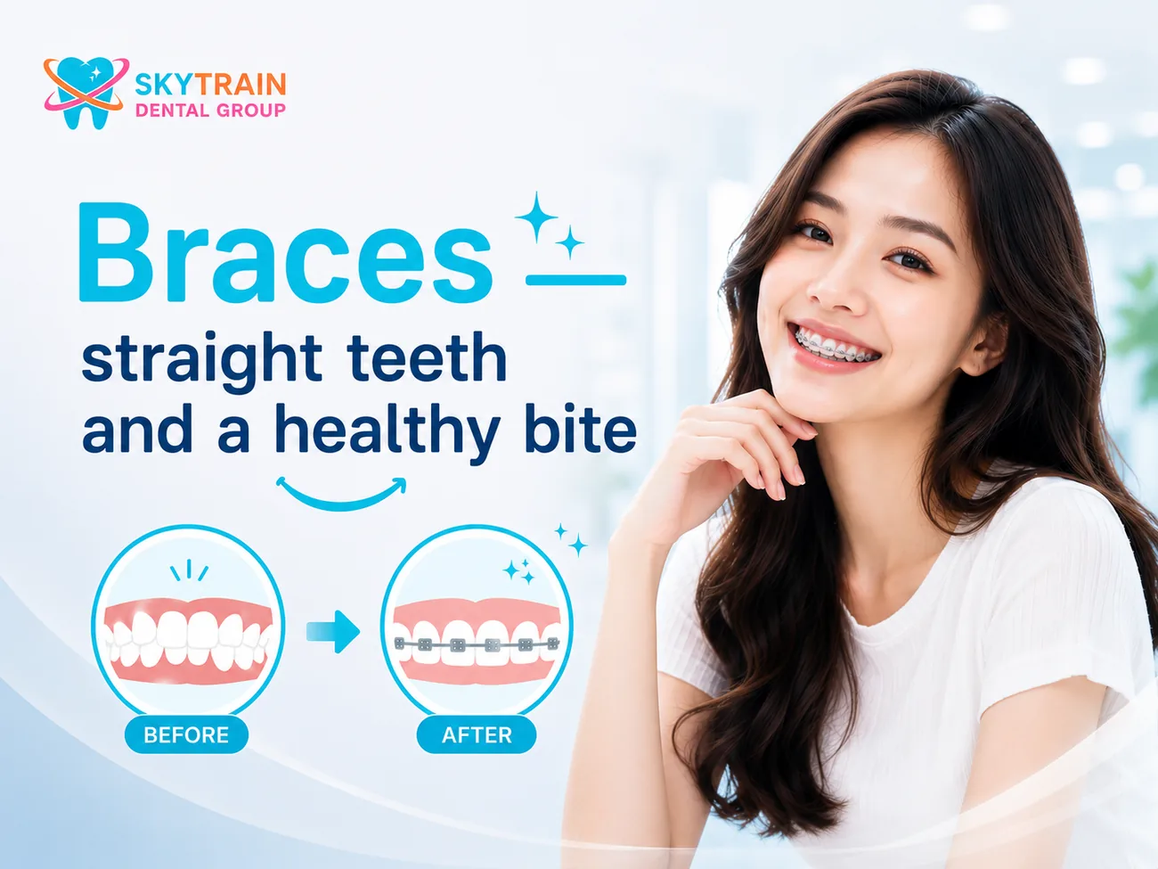 Braces สกายเทรน เด็นทัล