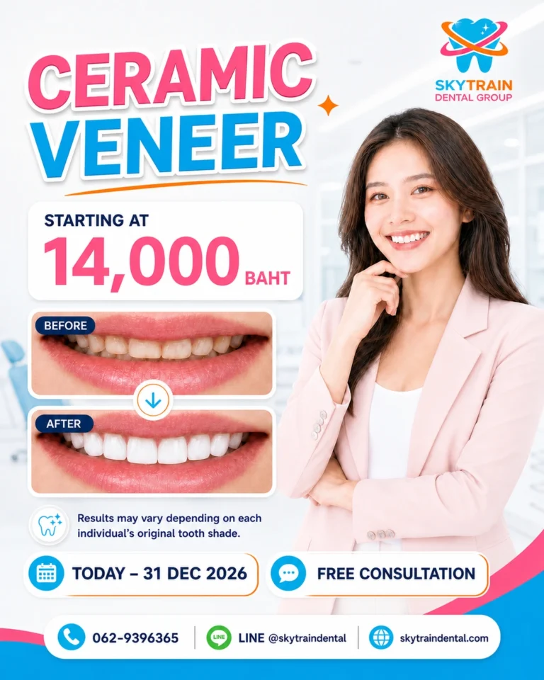 Ceramic Veneer