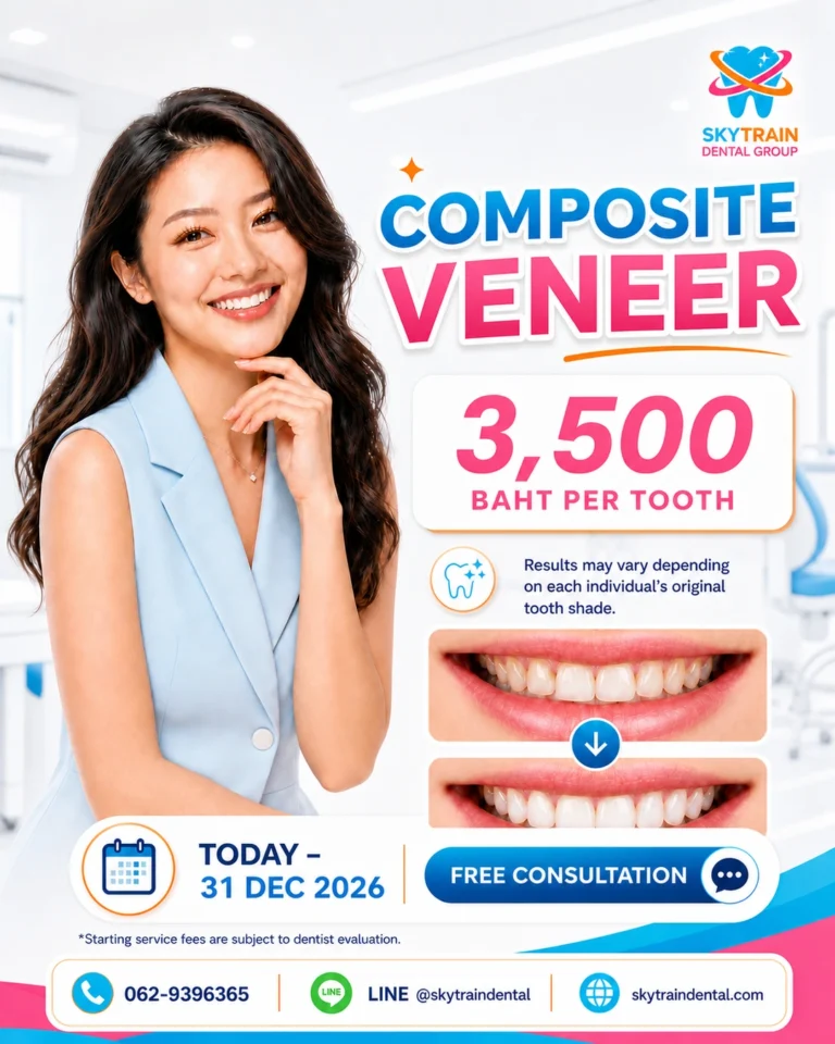 Composite Veneer