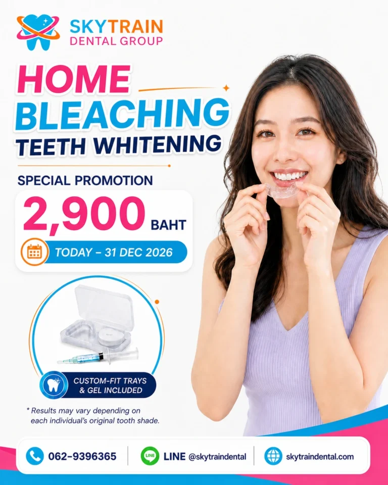 Home Bleaching Teeth Whitening