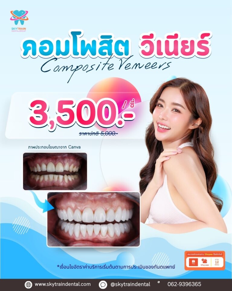คอมโพสิตวีเนียร์