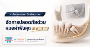 ผ่าฟันคุดเคสยาก ติดเส้นประสาท จัดการอย่างไรให้ปลอดภัย?